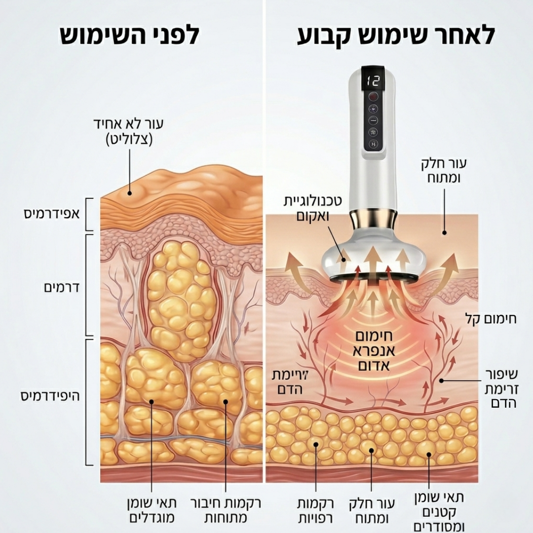 Shiroka DermaVac™ - עיסוי ואקום חכם להפחתת צלוליט ועיצוב הגוף